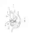 Fig. 09 - Bone cleaning assembly with a rotating cutting flute that is surrounded by a rotating shaving tube