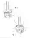 Fig. 02 - Peripheral peg drill component