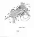 Fig. 02 - TISSUE CAVITATION DEVICE AND METHOD