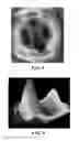 Fig. 04 - Methods and Compositions for Articular Repair
