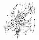Fig. 01 - Surgical guide instrument and system for ACL reconstruction and method of using same