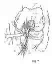 Fig. 08 - Surgical guide instrument and system for ACL reconstruction and method of using same