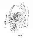 Fig. 10 - Surgical guide instrument and system for ACL reconstruction and method of using same