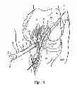 Fig. 13 - Surgical guide instrument and system for ACL reconstruction and method of using same