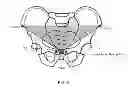 Fig. 04 - METHOD AND APPARATUS FOR DETERMINING THE ORIENTATION AND/OR POSITION OF AN OBJECT DURING A MEDICAL PROCEDURE