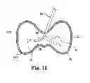 Fig. 15 - Device and method for delivering a curable material into bone