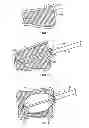 Fig. 02 - Methods and apparatus for treating vertebral fractures