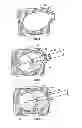 Fig. 03 - Methods and apparatus for treating vertebral fractures