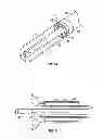 Fig. 05 - Methods and apparatus for treating vertebral fractures