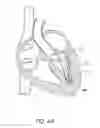 Fig. 43 - Suturing devices and methods for suturing an anatomic valve