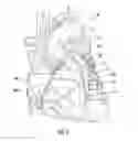 Fig. 02 - APPARATUS FOR BYPASS GRAFT