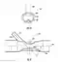 Fig. 08 - APPARATUS FOR BYPASS GRAFT