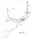 Fig. 19 - Thrombectomy Catheter System