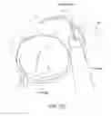 Fig. 05 - Water enucleation of the prostate