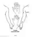 Fig. 03 - Method for the treatment of autism