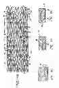 Fig. 04 - Hybrid stent and method of making