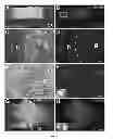 Fig. 02 - Methods for use of neural stem cell compositions for treatment of central nervous system lesions