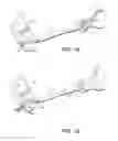 Fig. 20 - METHODS, DEVICES AND THERAPEUTIC PLATFORM FOR AUTOMATED, SELECTABLE, SOFT TISSUE RESECTION