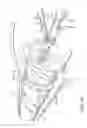 Fig. 22 - METHODS, DEVICES AND THERAPEUTIC PLATFORM FOR AUTOMATED, SELECTABLE, SOFT TISSUE RESECTION