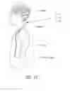 Fig. 12 - Smart shunt devices and methods