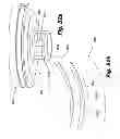 Fig. 47 - System and method for improved gas recirculation in surgical trocars with pneumatic sealing