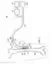 Fig. 02 - Sleeves, manifolds, systems, and methods for applying reduced pressure to a subcutaneous tissue site