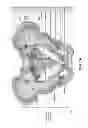 Fig. 02 - Intramedullary fixation system for management of pelvic and acetabular fractures