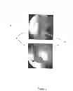 Fig. 09 - Devices and methods for interlocking surgical screws and nails