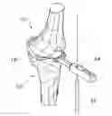 Fig. 01 - Methods and apparatus for performing knee arthroplasty