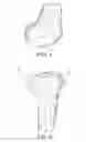 Fig. 02 - Methods and apparatus for performing knee arthroplasty
