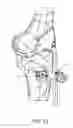 Fig. 28 - Methods and apparatus for performing knee arthroplasty
