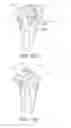 Fig. 49 - Methods and apparatus for performing knee arthroplasty