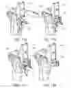 Fig. 53 - Methods and apparatus for performing knee arthroplasty