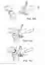 Fig. 64 - Methods and apparatus for performing knee arthroplasty