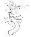 Fig. 01 - Arterial device, system and method for removing embolic debris
