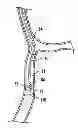 Fig. 01 - Occlusion traversal robotic catheter system