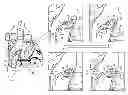 Fig. 01 - Fossa ovalis penetration