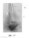 Fig. 45 - Minimally invasive surgical devices and methods