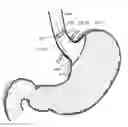 Fig. 01 - Bariatric device and method