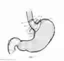 Fig. 02 - Bariatric device and method