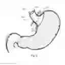Fig. 07 - Bariatric device and method