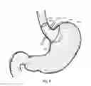 Fig. 09 - Bariatric device and method