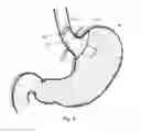 Fig. 10 - Bariatric device and method