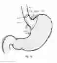 Fig. 11 - Bariatric device and method