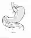 Fig. 12 - Bariatric device and method