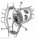 Fig. 01 - ATRIAL SEPTAL OCCLUDER DEVICE AND METHOD