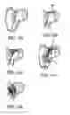 Fig. 08 - ATRIAL SEPTAL OCCLUDER DEVICE AND METHOD