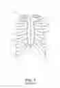 Fig. 02 - Sternum fixation device and method