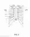 Fig. 03 - Sternum fixation device and method