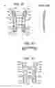Fig. 03 - Bending tool and method for reshaping a bone plate